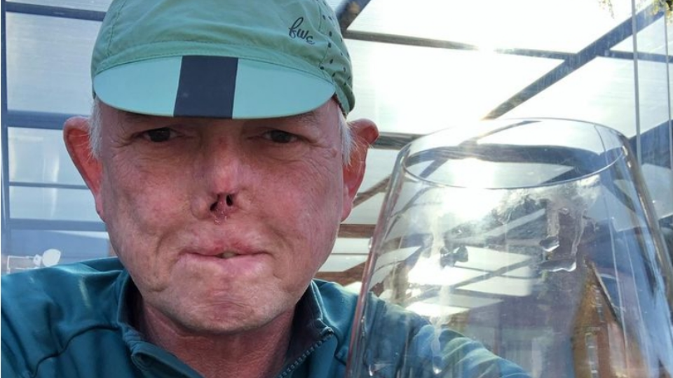  Pierde piernas y parte de la cara por un infección de su perro