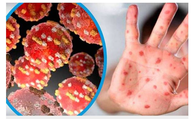  Detectan dos posibles casos de mpox en Ciudad Juárez