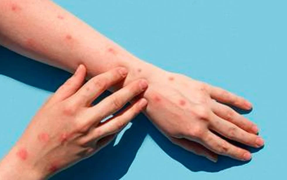  Alemania reporta primer caso de nueva variante de mpox